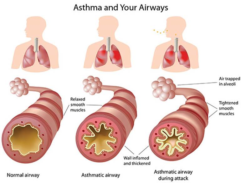 "Asthma and Your Airways" by unknown. is licensed under CC BY-NC-SA 3.0 Access for free at https://humannhealth.com/what-you-need-to-know-about-asthma/341/ llustration of how asthma affects the airways