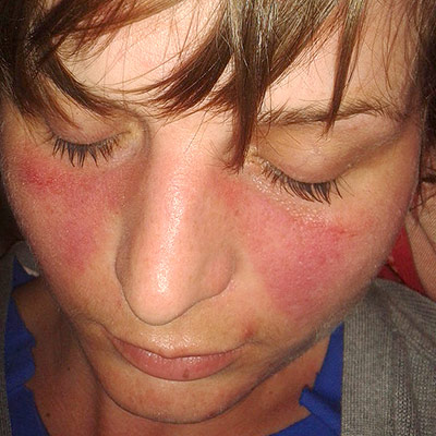 “Lupusfoto.jpg” by Doktorinternet is licensed under CC BY-SA 4.0 Image showing a person with Butterfly Rash on the Face Associated With SLE